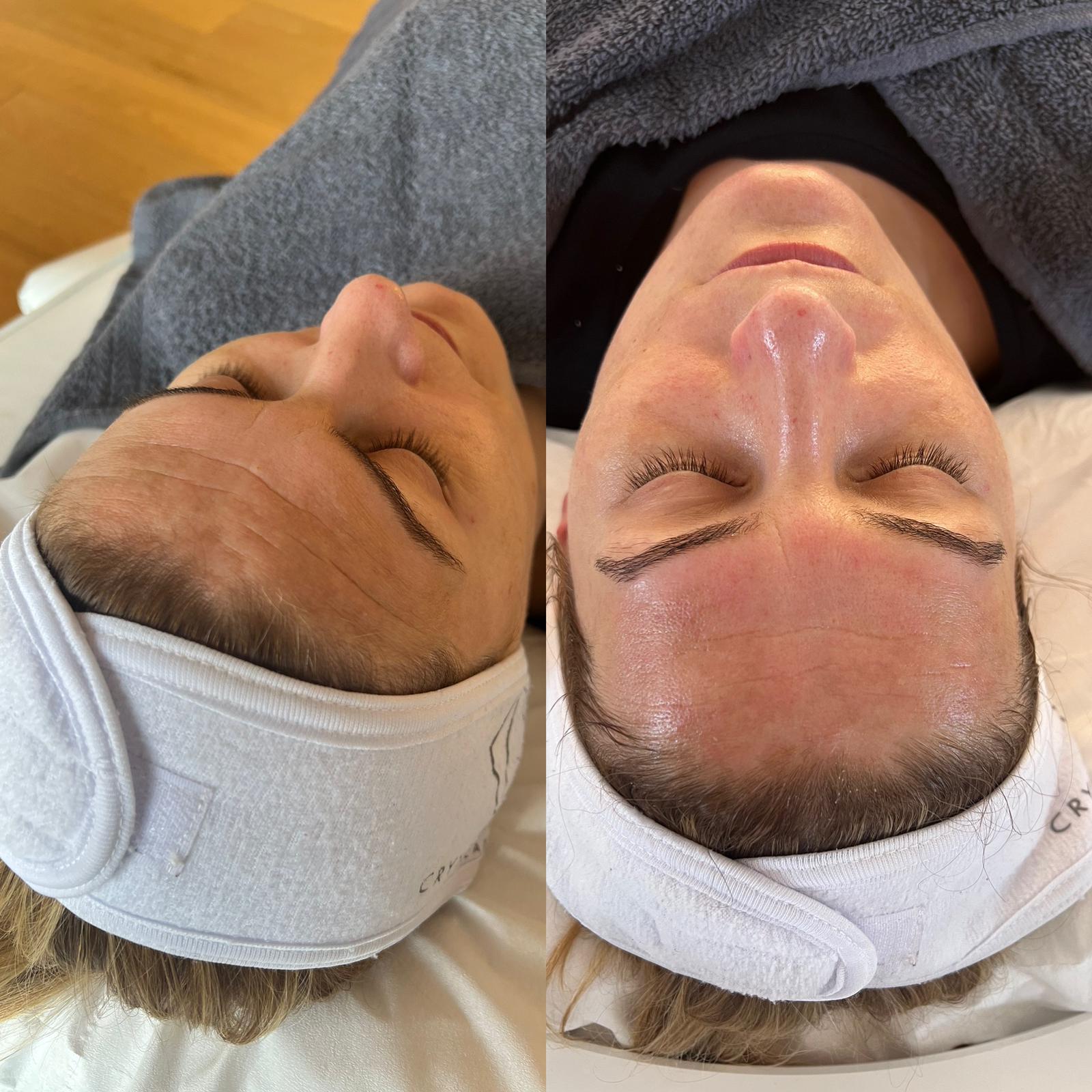 Skinstorm resultaten voor en na